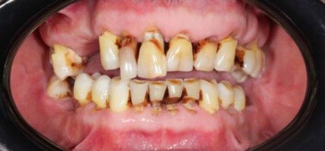 Стирание зубов и клиновидный дефект причины: