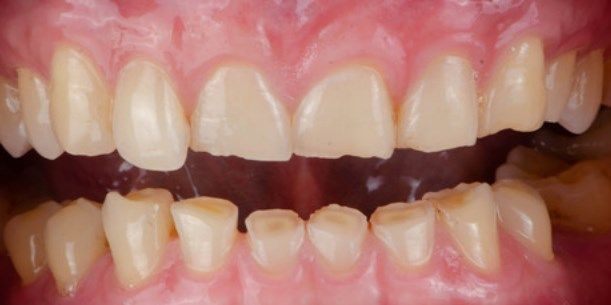 Зуб после обточки: современные методы восстановления, виды протезов