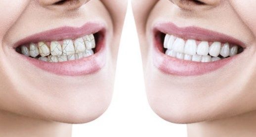 Как восстановить эмаль зубов в домашних условиях