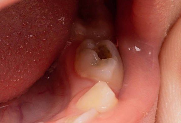 Полное разрушение коронковой части зуба