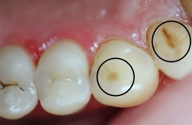 Как избавиться от кариеса в стадии пятна отзывы стоматология нежность томск