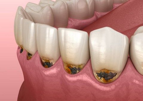Кариес корня зуба. Методы лечения и профилактика