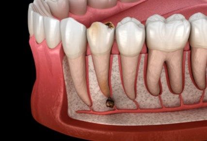 Особенности пульпита на передних зубах