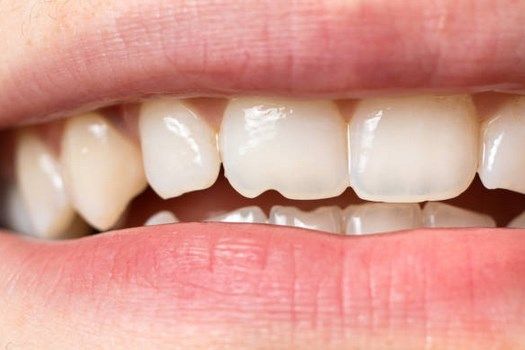 Чем опасны трещины на эмали зубов?
