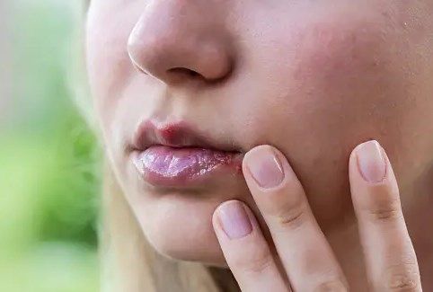 Рак губы: признаки и симптомы