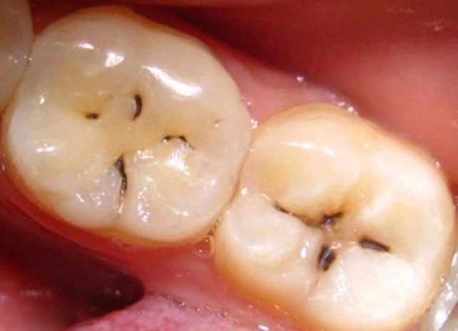 Кариес зубов - симптомы и диагностика, причины осложнений, классификация