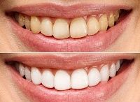Что такое тетрациклиновые зубы?