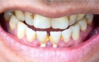 Что такое зубные камни? Они опасны?
