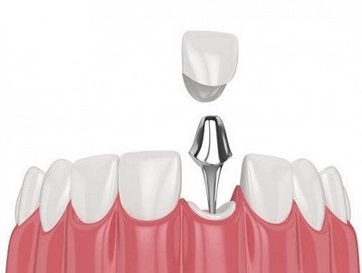 Как происходит удаление корня зуба и зачем нужна эта операция | Кармэн-Мед